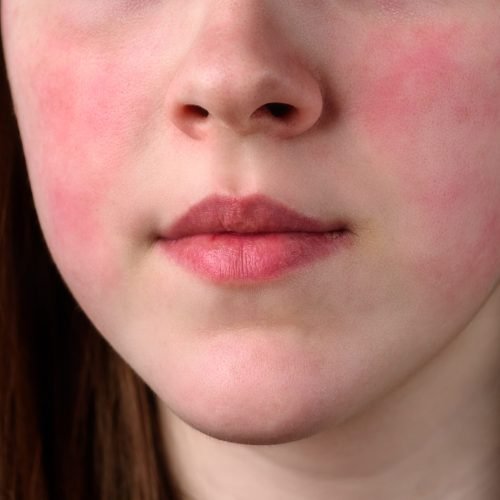 Close up view on the cheek of a woman with red cheeks after the wind. Allergy concept.