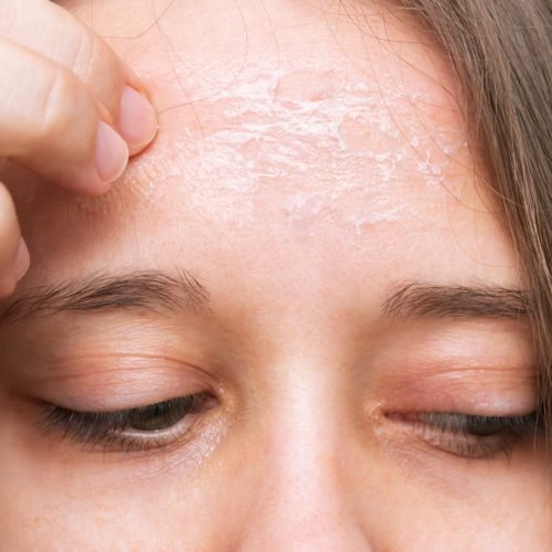 female-forehead-with-peeling-skin-allergies-eczema-psoriasis-lack-vitamins-erythema-itching
