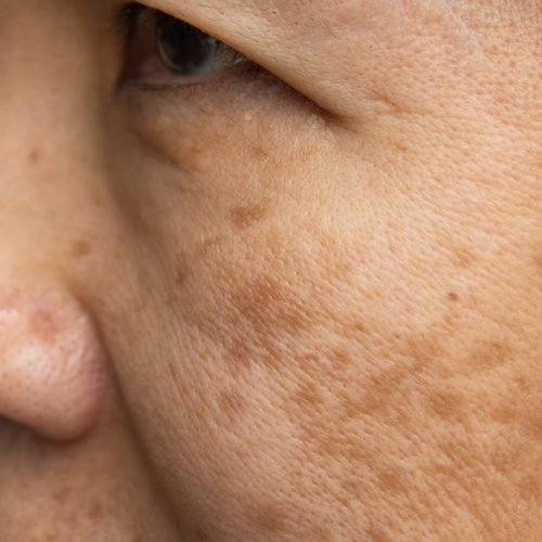 Menopausal women worry about melasma on face.