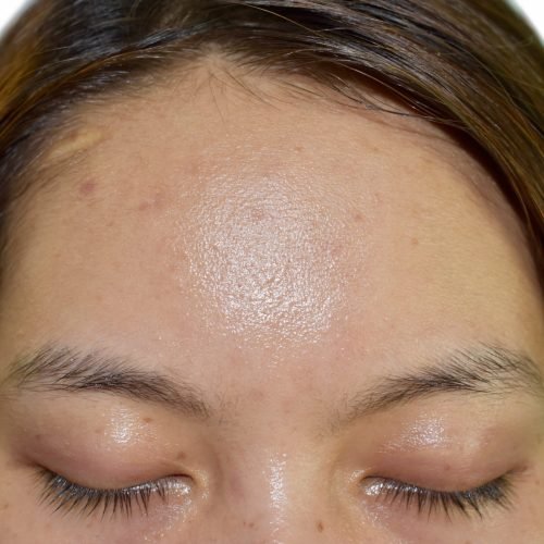 Oily skin with wide forehead of Southeast Asian, Myanmar or Korean adult young woman. Closeup view.