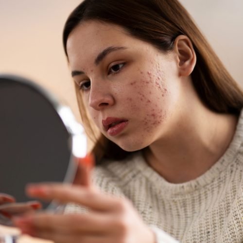 person-dealing-with-rosacea (1)