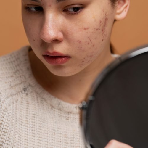 person-dealing-with-rosacea (2)