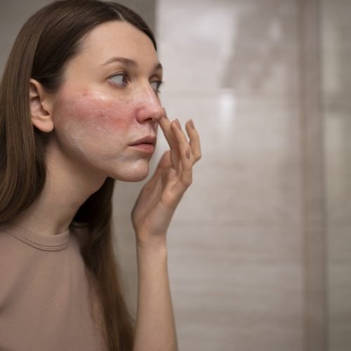 woman-looking-her-rosacea-mirror