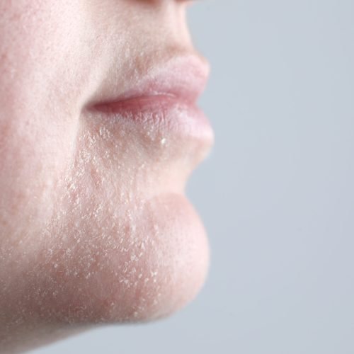 Woman with dry skin on face against light grey background, closeup. Space for text