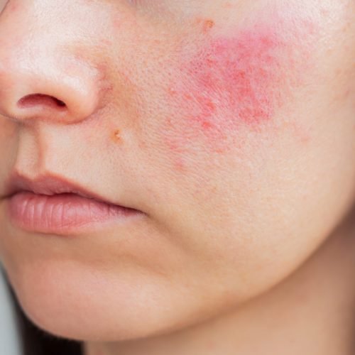 young-woman-suffering-from-rosacea-her-face-acute-stage-skin-chronic-disease